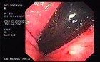 Rectal Amebiasis (2 of 2)