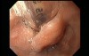 Endotracheal Tube