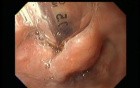 Endotracheal Tube