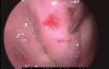 Eustachian Tuboplasty