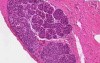 Lobular carcinoma in situ - Histopathology - Breast