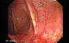 Colonic Lymphoma (4 of 6)