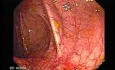 Colonic Lymphoma (4 of 6)