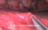 Uniportal VATS Lobectomy Lung Cancer