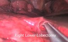 Uniportal VATS Lobectomy Lung Cancer