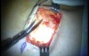 Autologous Bone Grafting (1/4)