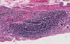 Stomach - Chronic Gastritis