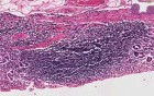 Stomach - Chronic Gastritis