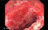 Colonic Lymphoma (2 of 6)