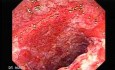 Colonic Lymphoma (2 of 6)