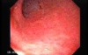 Ileal Neobladder Substitution (ileal bladder) (1 of 9)