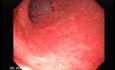 Ileal Neobladder Substitution (ileal bladder) (1 of 9)