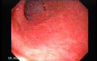 Ileal Neobladder Substitution (ileal bladder) (1 of 9)