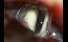 Trigeminal neuralgia-microvascular decompression - Dr Suresh Dugani/HUBLI/INDIA