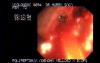 Video Colonoscopic view of a polypectomy of a big 6 cm. x 4 cm. sessile lesion (3 of 4)
