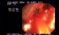 Video Colonoscopic view of a polypectomy of a big 6 cm. x 4 cm. sessile lesion (3 of 4)