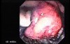 Adenocarcinoma of Papilla of Vater (5 of 5)