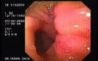 Gastric Submucosal Nodules (3 of 3)