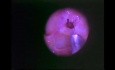 Functional Endoscopic Sinus Surgery - Anatomical Demostration - Part 5 of 5