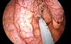 Appendectomy - transumbilical access