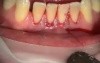 How To Cover Recession With Collagen Implant