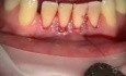How To Cover Recession With Collagen Implant