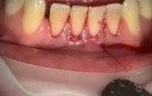 How To Cover Recession With Collagen Implant