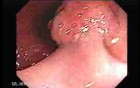 Large Tubulo-Villous Adenoma (4 of 6)