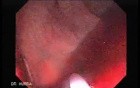 Endoscopic Resection of Giant Tubulo-Villous of the rectum (15 of 35)