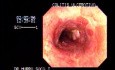 Ulcerative Colitis