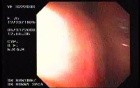Upper Gastrointestinal Bleeding (12 of 15)