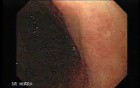Gastrointestinal Stromal Tumor - GIST (6 of 13)