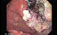 Esophageal Squamous Cell Carcinoma (4 of 5)