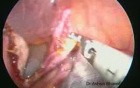 Laparoscopic Ovarian Cystectomy