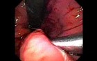 Retrograde Gastroplicature - Suturing - 1/3