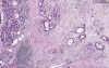 Adenocarcinoma - Histopathology of pancreas