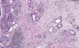 Adenocarcinoma - Histopathology of pancreas