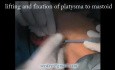 Face lift with retrolobular incision