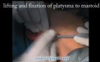 Face lift with retrolobular incision