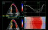 Dobutamine Echocardiogram