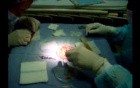 Hair transplantation surgery