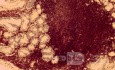 Gastric lymphoma with metastases to the duodenum (13 of 15)