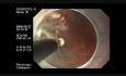 ESD For Barrett's Cancer Developed From LSBE