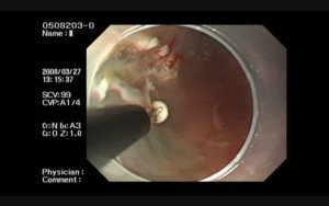 ESD For Barrett's Cancer Developed From LSBE