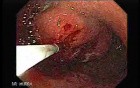 Gastrointestinal Stromal Tumor - GIST (7 of 13)