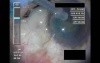 Swollen Conjunctiva - Part 2