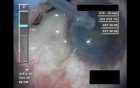 Swollen Conjunctiva - Part 2