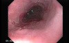 Barrett Esophagus - endoscopic view  (9 of 9)