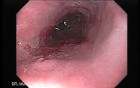 Barrett Esophagus - endoscopic view  (9 of 9)