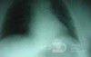 Large Gastric Varices (23 of 25)